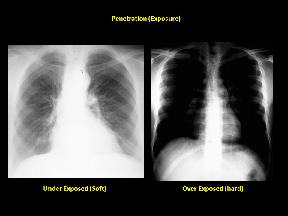 exposure to x ray