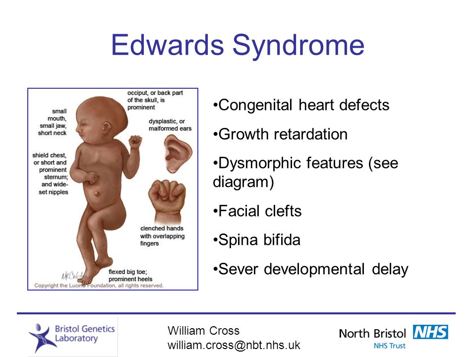 How long do adults with down syndrome live