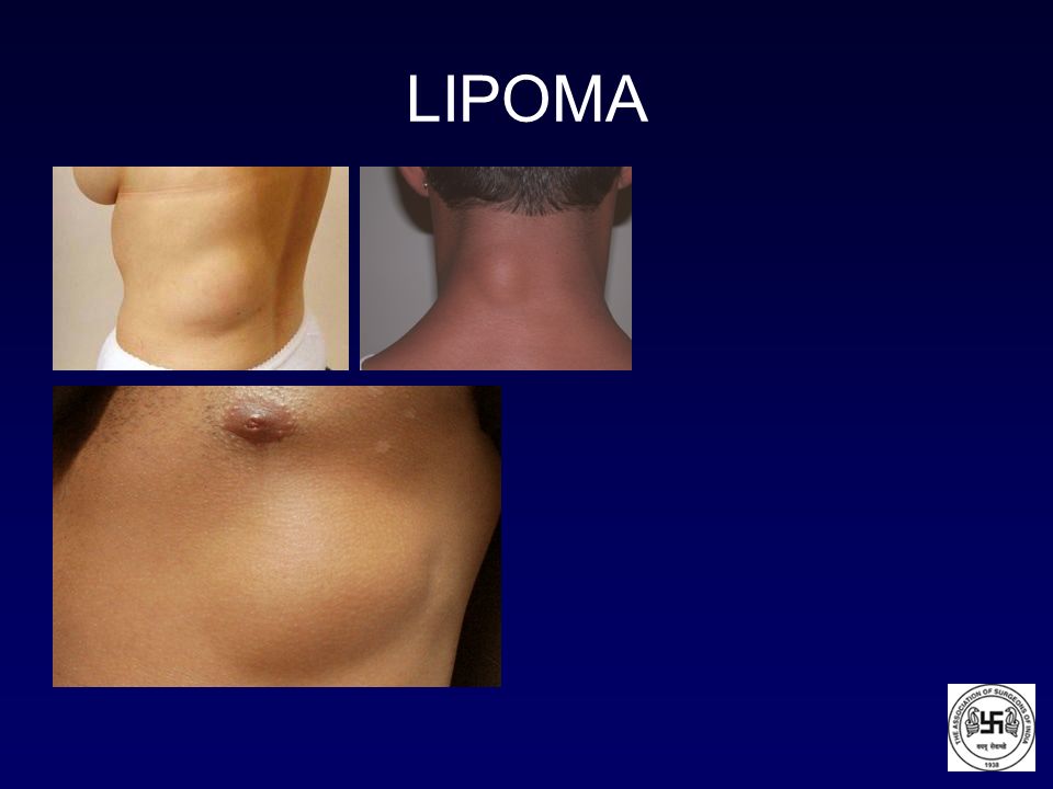 LIPOMA PPT lipoma ppt: