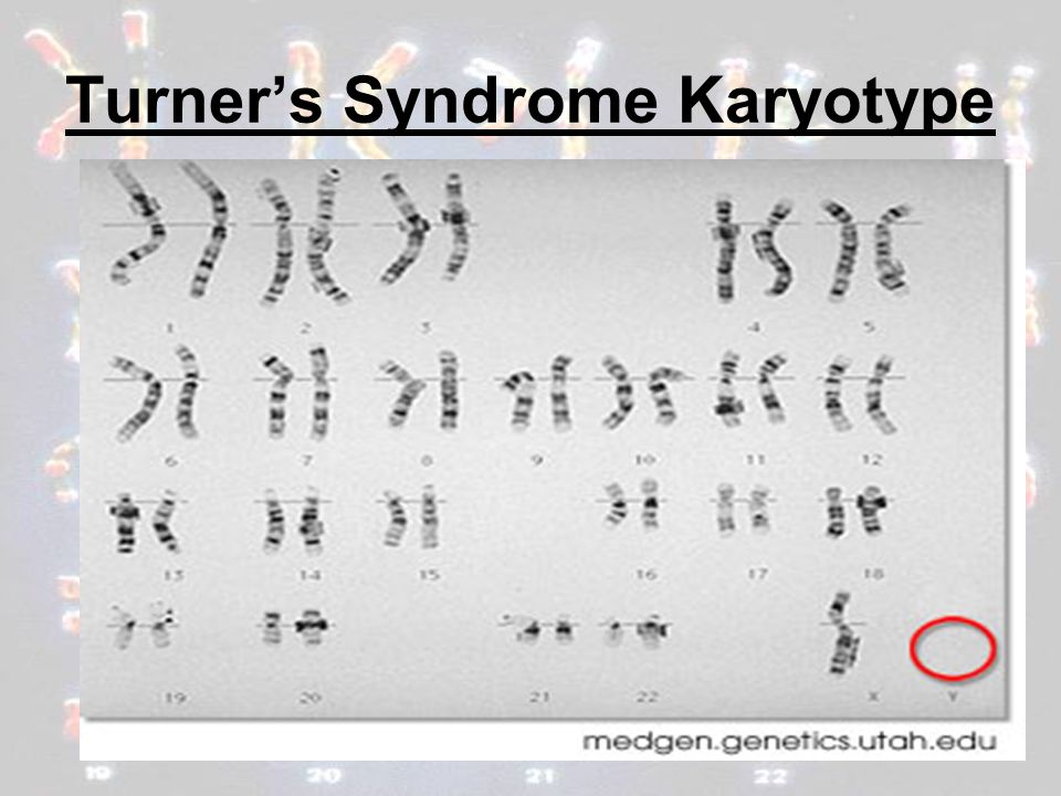 turner syndrome research paper turner syndrome research paper