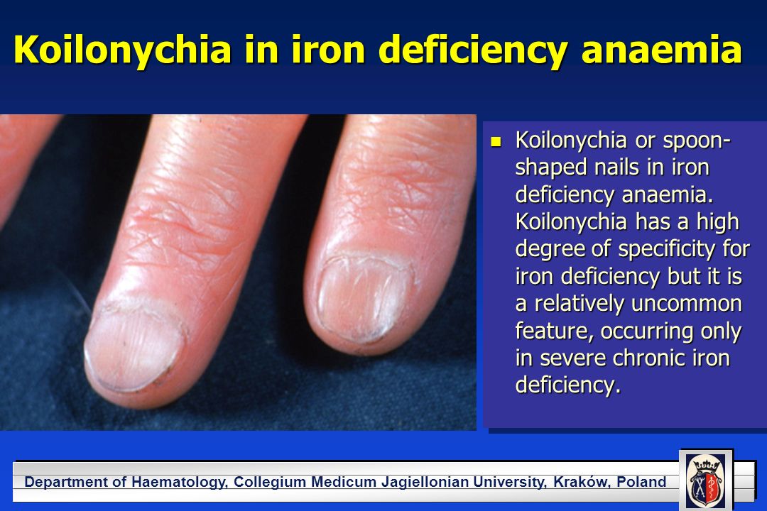 Spoon Shaped Nails Iron Deficiency Anemia Best Nail Designs 2018 Your Logo Here Department Of Haematology Collegium Medi