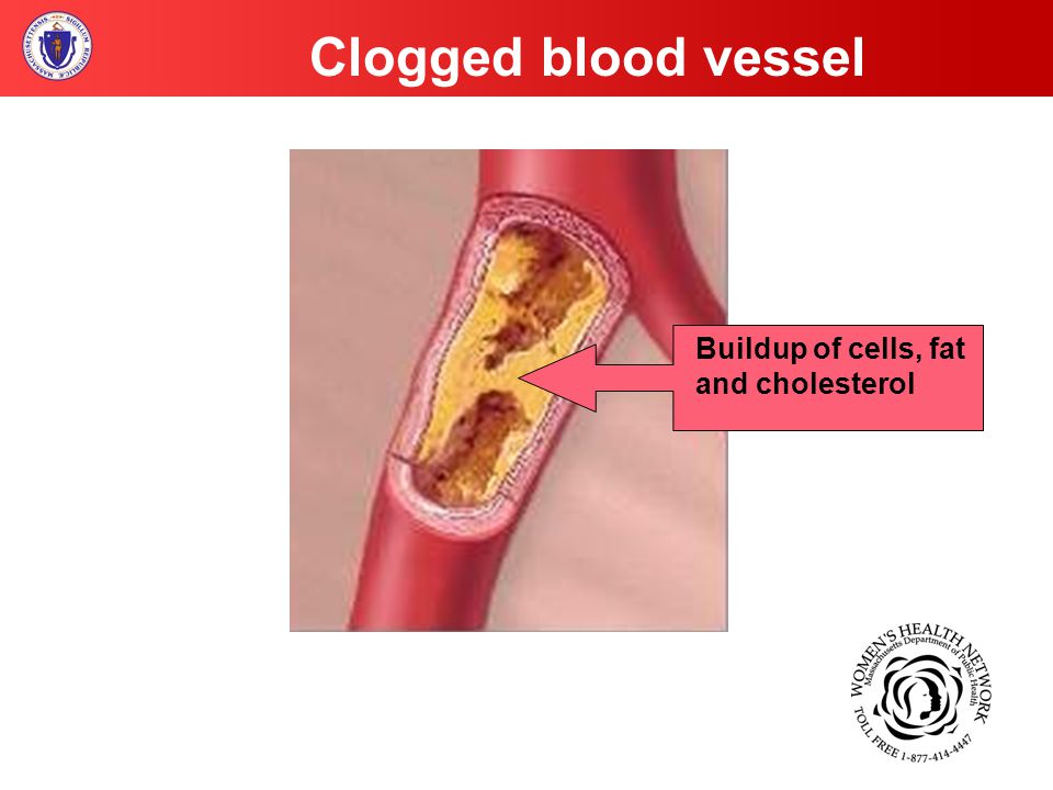 Clogged blood vessel Buildup of cells, fat and cholesterol