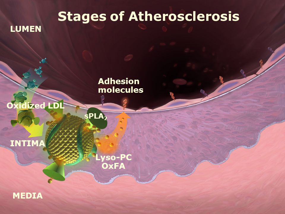 LUMEN MEDIA INTIMA Oxidized LDL Adhesion molecules Lyso-PC OxFA sPLA 2 Stages of Atherosclerosis