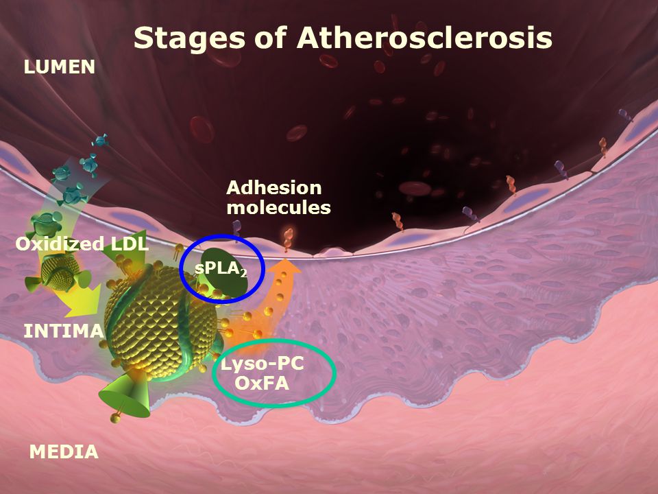 LUMEN MEDIA INTIMA Oxidized LDL Adhesion molecules Lyso-PC OxFA sPLA 2 Stages of Atherosclerosis