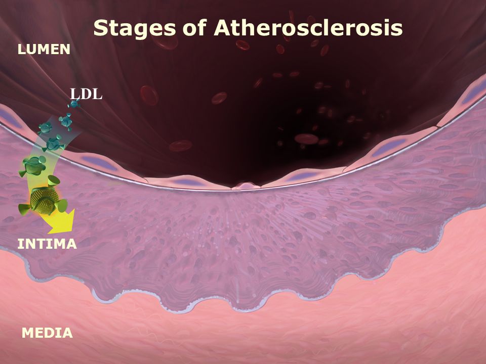 LUMEN MEDIA INTIMA Stages of Atherosclerosis LDL