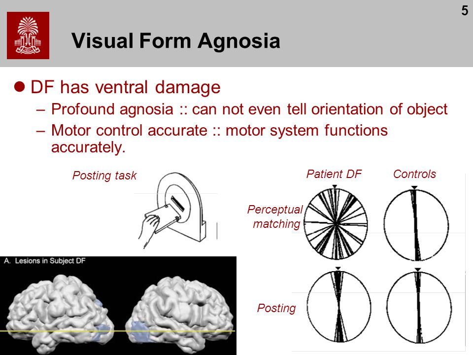 1 motor control chris rorden ataxia apraxia motor neurons visual form agnosia
