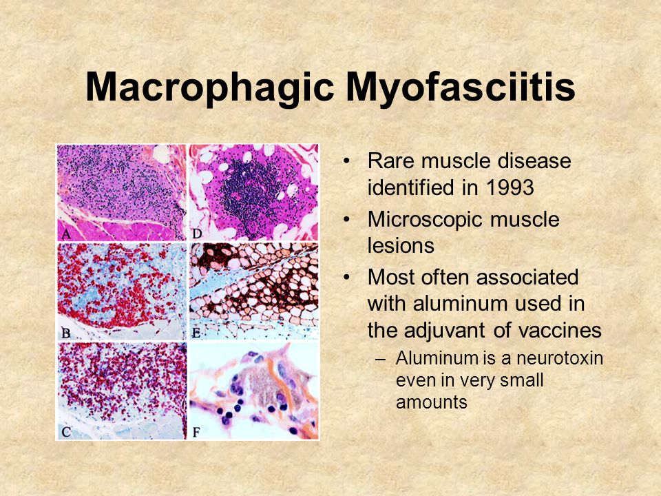 Image result for Myofasciitis