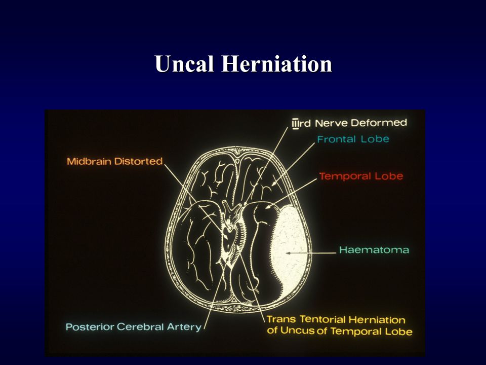 Uncal Herniation