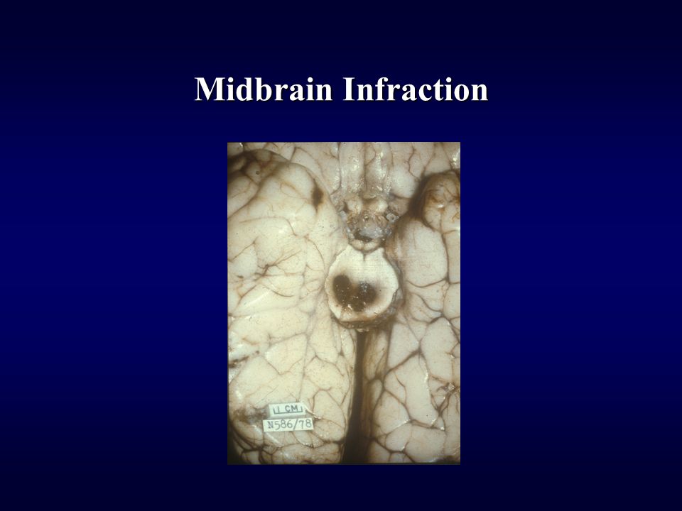 Midbrain Infraction