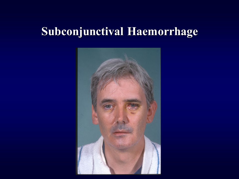 Subconjunctival Haemorrhage