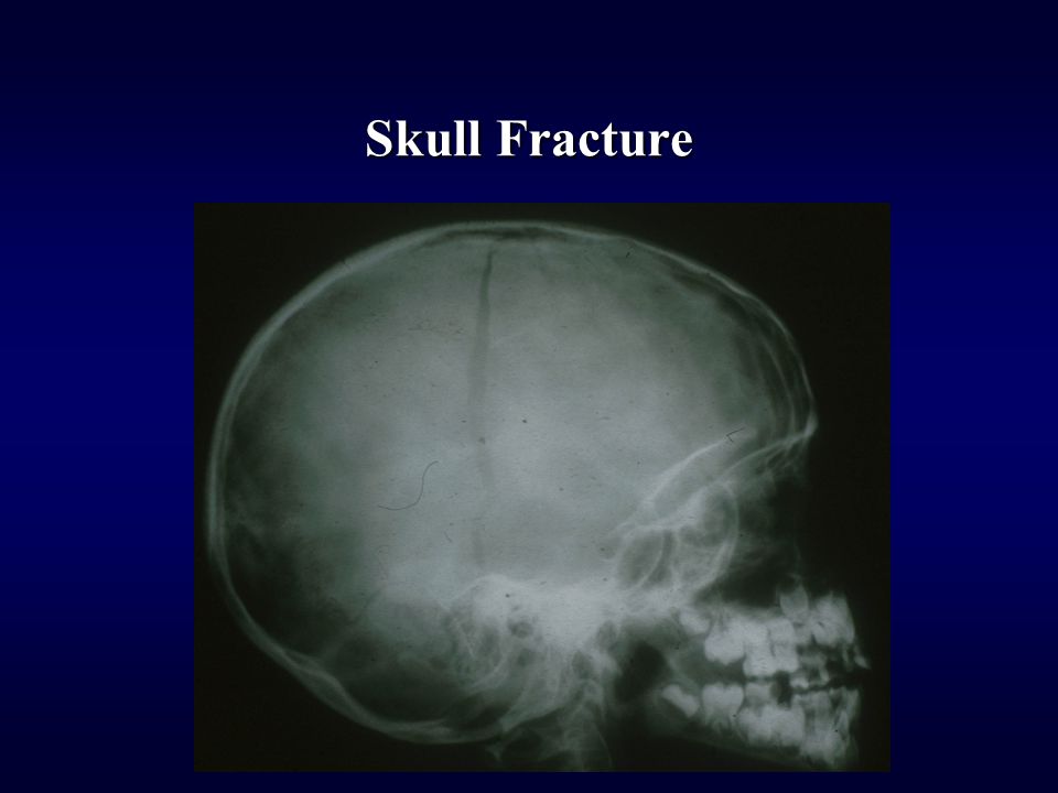 Skull Fracture