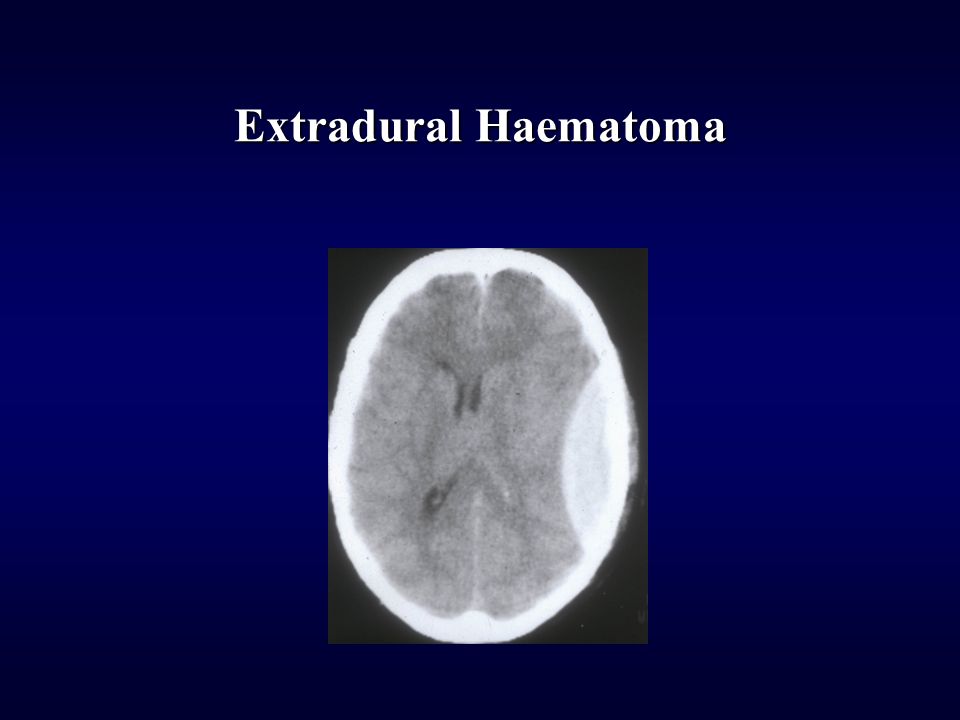 Extradural Haematoma