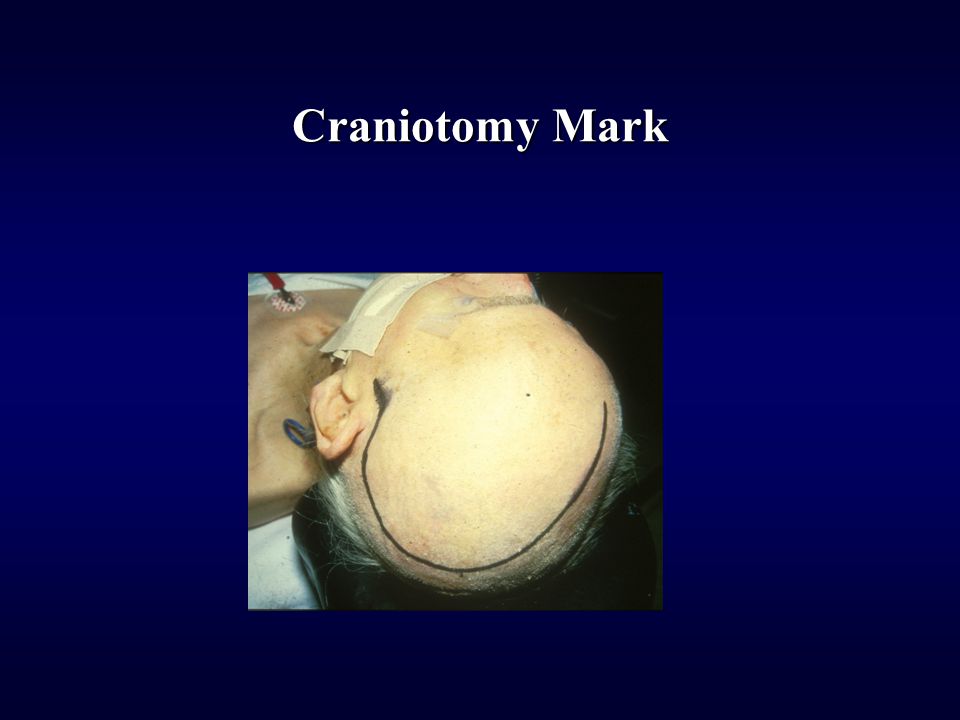 Craniotomy Mark