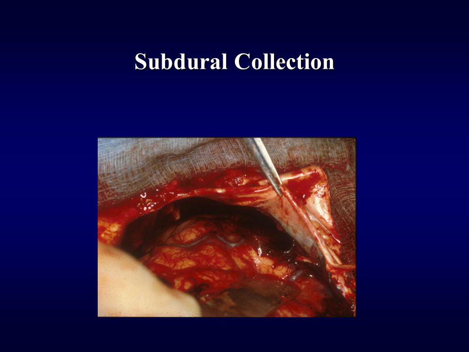 Subdural Collection