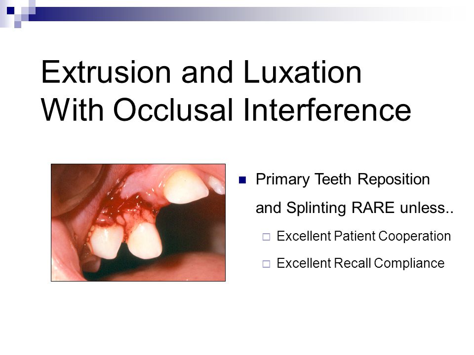 tooth luxation