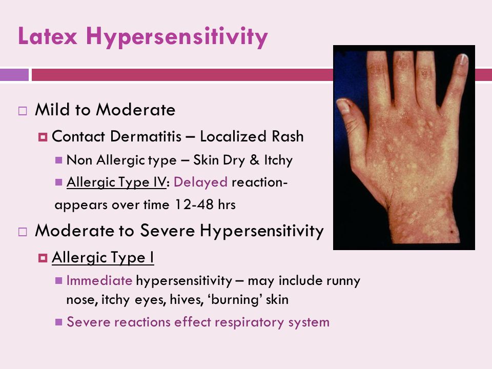 Latex Hypersensitivity  Mild to Moderate  Contact Dermatitis – Localized Rash Non Allergic type – Skin Dry & Itchy Allergic Type IV: Delayed reaction- appears over time hrs  Moderate to Severe Hypersensitivity  Allergic Type I Immediate hypersensitivity – may include runny nose, itchy eyes, hives, ‘burning’ skin Severe reactions effect respiratory system  Mild to Moderate  Contact Dermatitis – Localized Rash Non Allergic type – Skin Dry & Itchy Allergic Type IV: Delayed reaction- appears over time hrs  Moderate to Severe Hypersensitivity  Allergic Type I Immediate hypersensitivity – may include runny nose, itchy eyes, hives, ‘burning’ skin Severe reactions effect respiratory system