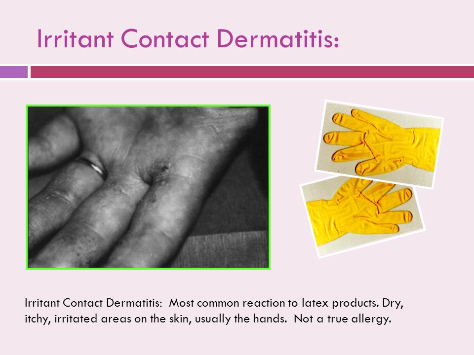 Irritant Contact Dermatitis: Irritant Contact Dermatitis: Most common reaction to latex products.