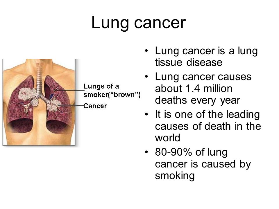 Lung cancer Lung cancer is a lung tissue disease Lung cancer causes about 1.4 million deaths every year It is one of the leading causes of death in the world 80-90% of lung cancer is caused by smoking