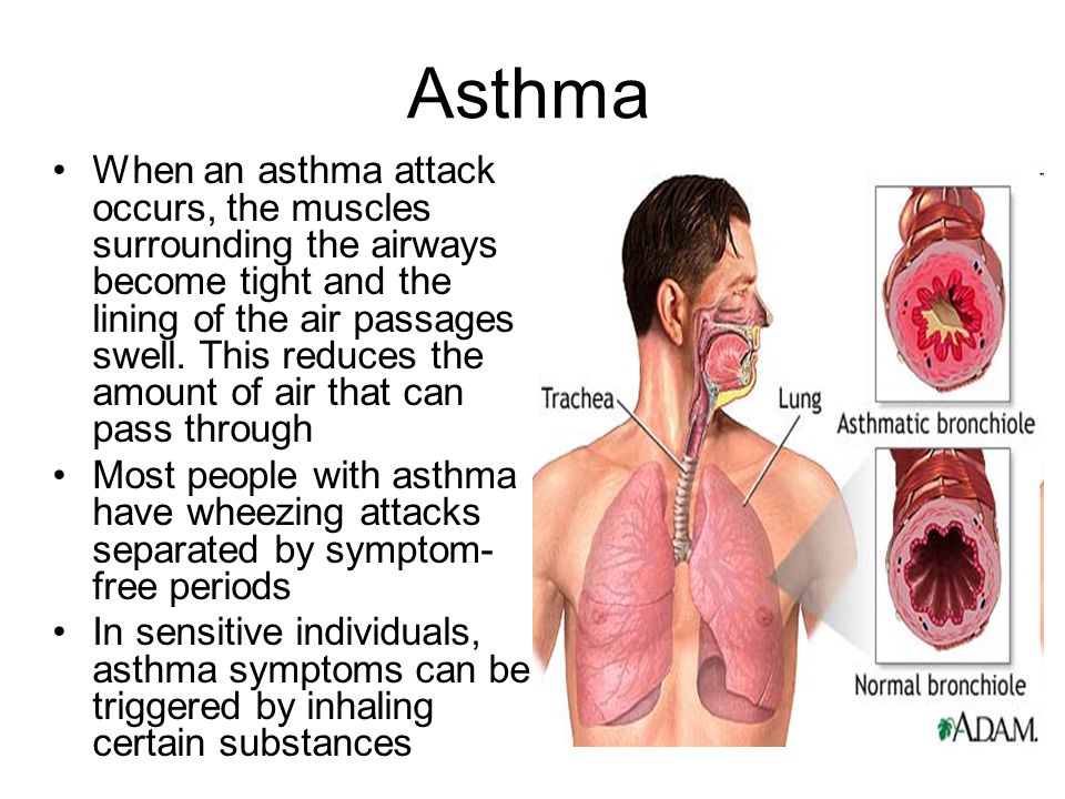 Asthma When an asthma attack occurs, the muscles surrounding the airways become tight and the lining of the air passages swell.