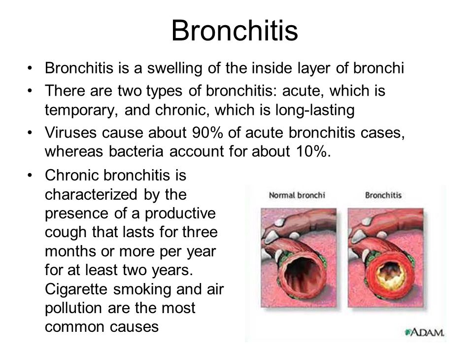 Bronchitis Bronchitis is a swelling of the inside layer of bronchi There are two types of bronchitis: acute, which is temporary, and chronic, which is long-lasting Viruses cause about 90% of acute bronchitis cases, whereas bacteria account for about 10%.