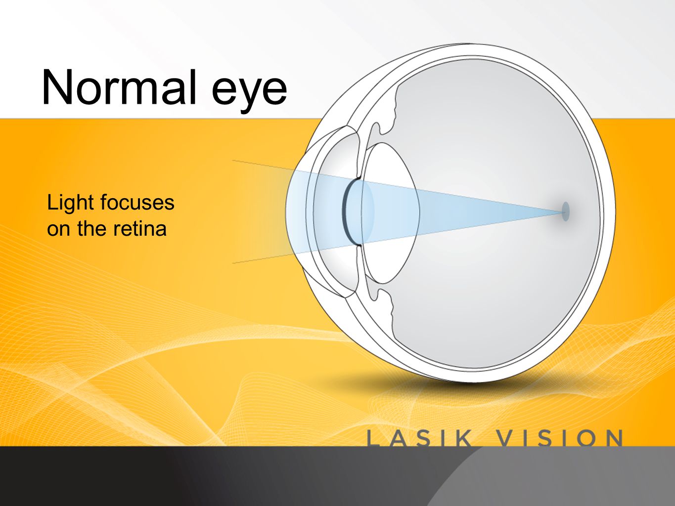 Normal eye Light focuses on the retina