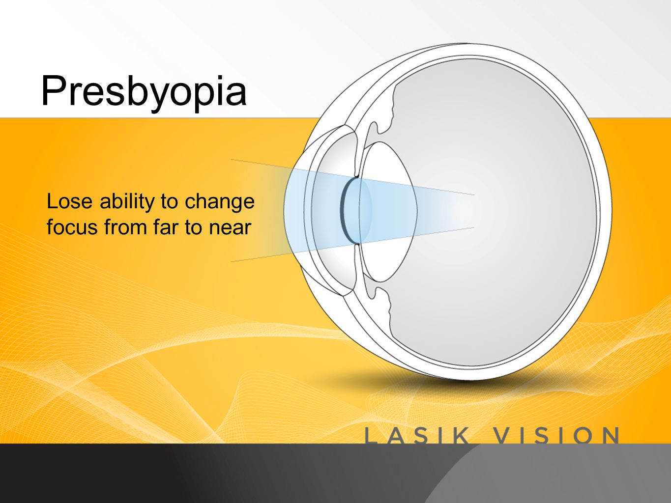 Lose ability to change focus from far to near Presbyopia