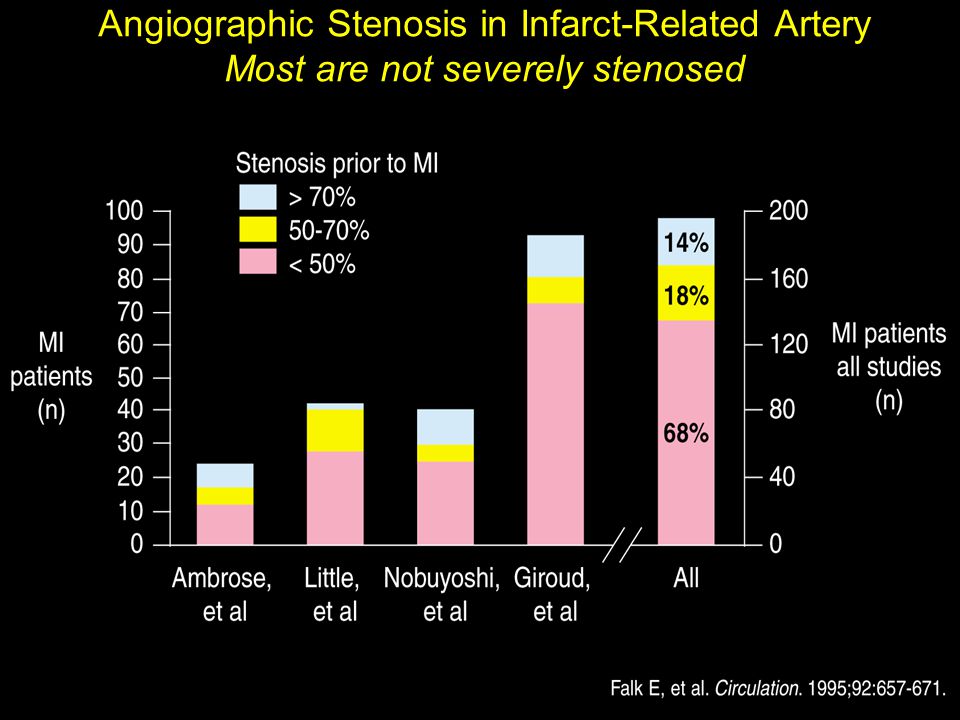 Angiographic Stenosis in Infarct-Related Artery Most are not severely stenosed