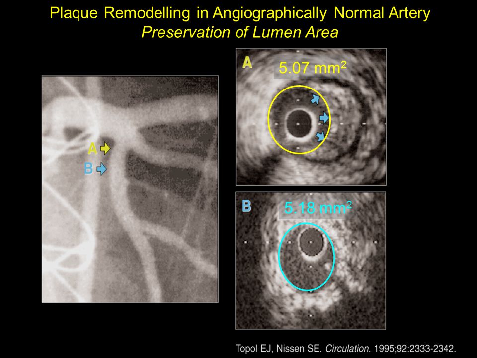 5.07 mm mm 2 Plaque Remodelling in Angiographically Normal Artery Preservation of Lumen Area