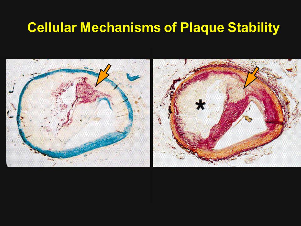 Cellular Mechanisms of Plaque Stability