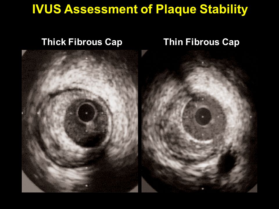 IVUS Assessment of Plaque Stability Thick Fibrous CapThin Fibrous Cap
