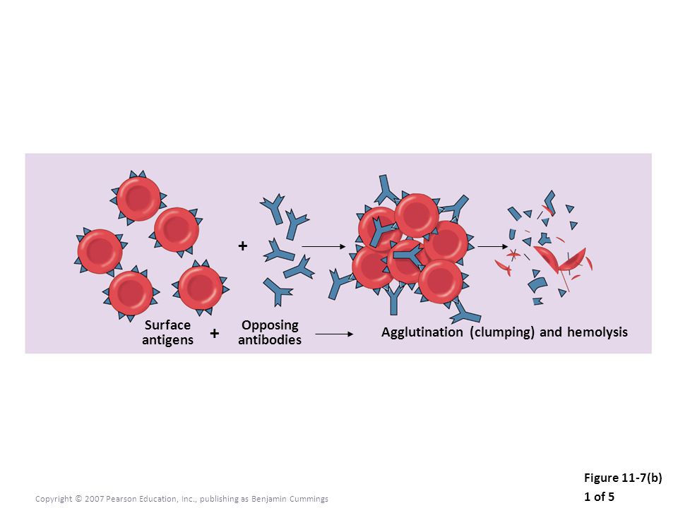 Figure 11-7(b) 1 of 5 Copyright © 2007 Pearson Education, Inc., publishing as Benjamin Cummings Surface antigens Opposing antibodies + + Agglutination (clumping) and hemolysis