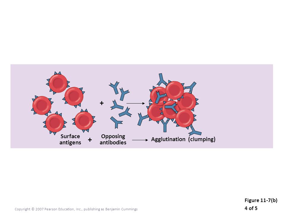 Figure 11-7(b) 4 of 5 Copyright © 2007 Pearson Education, Inc., publishing as Benjamin Cummings Surface antigens Opposing antibodies + + Agglutination (clumping)