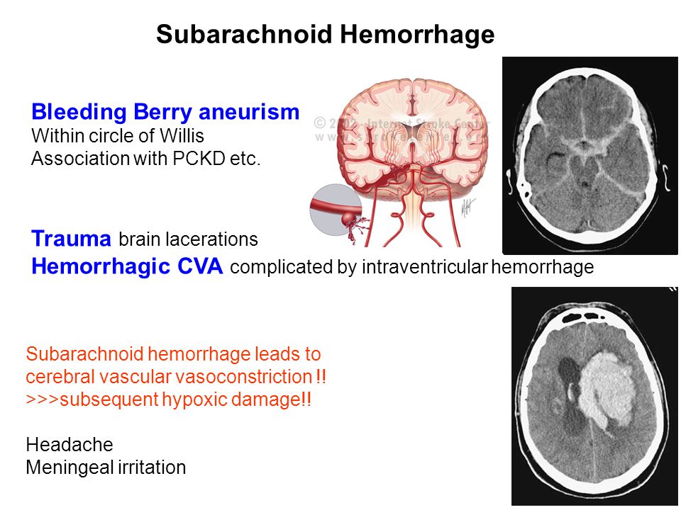 Viagra Cerebral Hemorrage