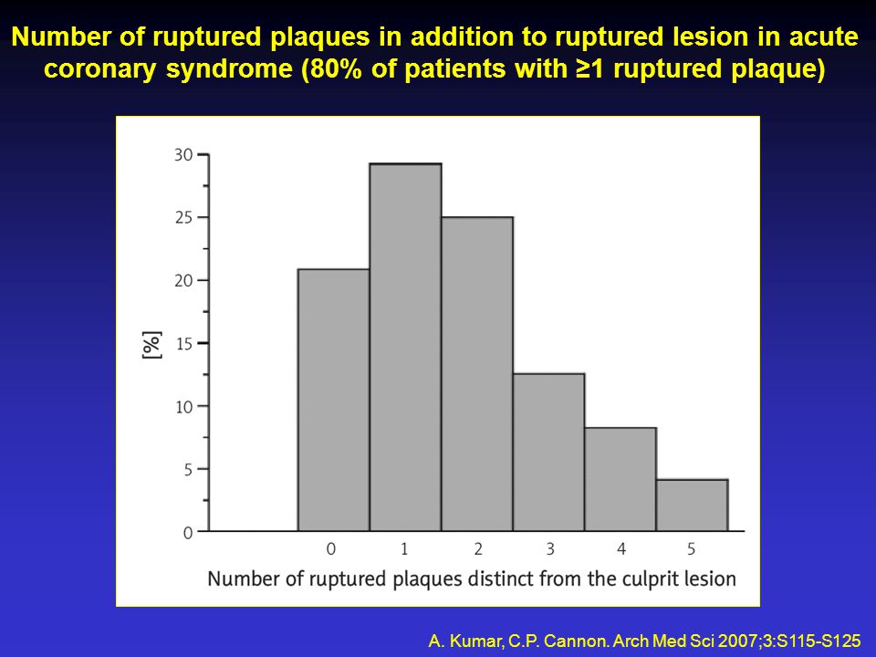 Number of ruptured plaques in addition to ruptured lesion in acute coronary syndrome (80% of patients with ≥1 ruptured plaque) A.