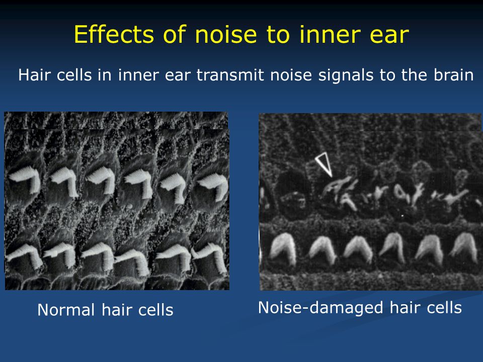 Effects of noise to inner ear Normal hair cells Noise-damaged hair cells Hair cells in inner ear transmit noise signals to the brain