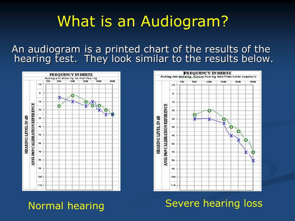 An audiogram is a printed chart of the results of the hearing test.