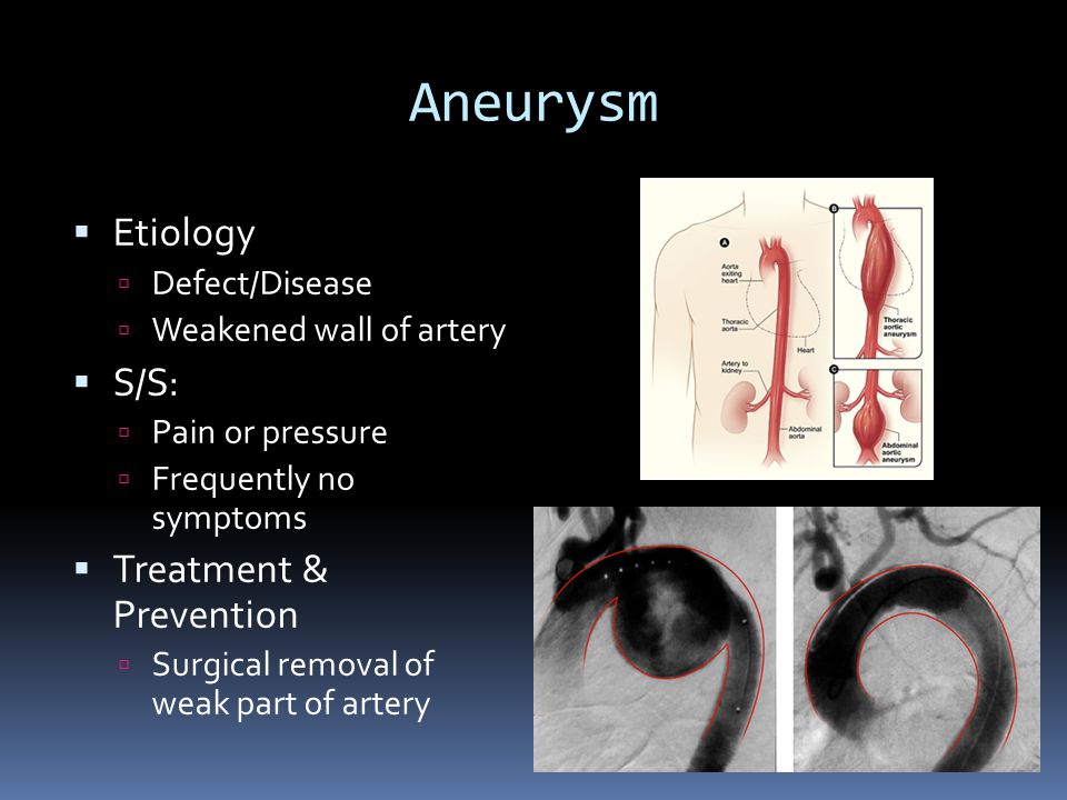 Aneurysm  Etiology  Defect/Disease  Weakened wall of artery  S/S:  Pain or pressure  Frequently no symptoms  Treatment & Prevention  Surgical removal of weak part of artery