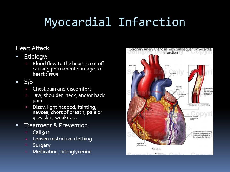 Myocardial Infarction Heart Attack  Etiology:  Blood flow to the heart is cut off causing permanent damage to heart tissue  S/S:  Chest pain and discomfort  Jaw, shoulder, neck, and/or back pain  Dizzy, light headed, fainting, nausea, short of breath, pale or grey skin, weakness  Treatment & Prevention:  Call 911  Loosen restrictive clothing  Surgery  Medication, nitroglycerine
