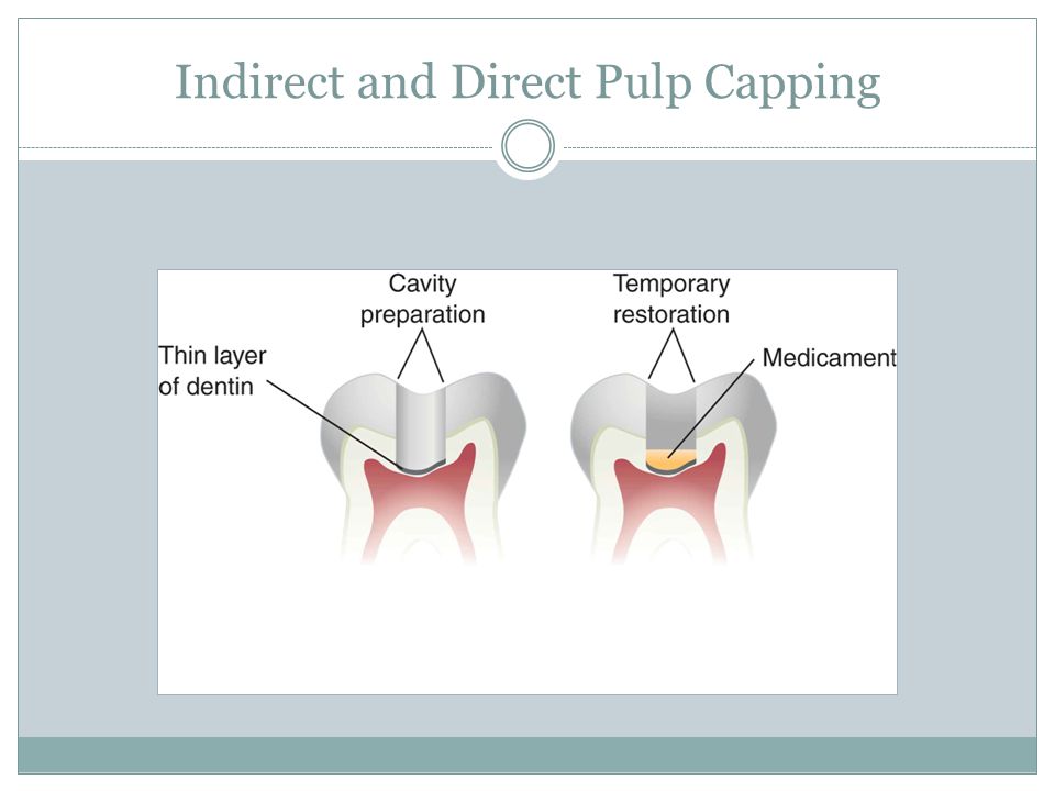 indirect pulp cap