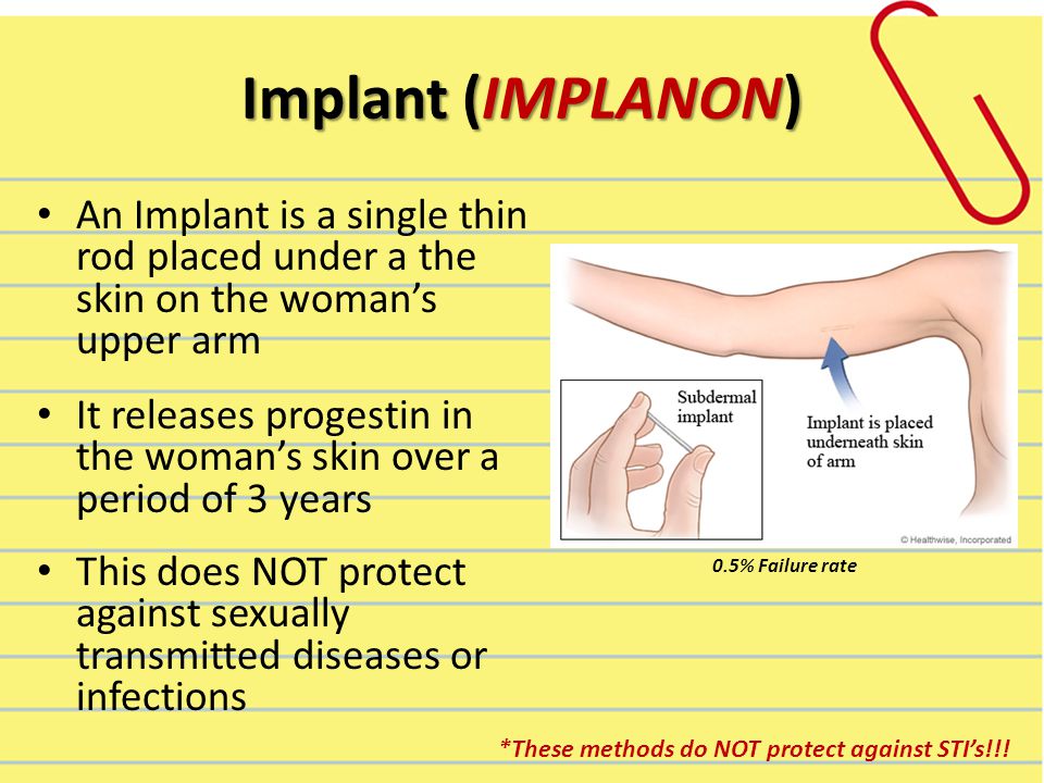 Implant (IMPLANON) An Implant is a single thin rod placed under a the skin on the woman’s upper arm It releases progestin in the woman’s skin over a period of 3 years This does NOT protect against sexually transmitted diseases or infections 0.5% Failure rate *These methods do NOT protect against STI’s!!!
