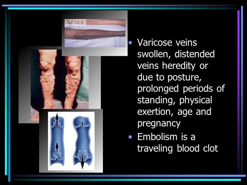 Varicose veins swollen, distended veins heredity or due to posture, prolonged periods of standing, physical exertion, age and pregnancy Embolism is a traveling blood clot