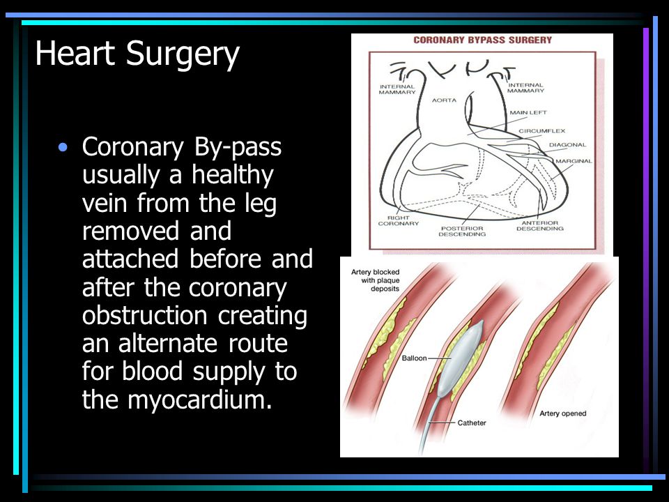 Heart Surgery Coronary By-pass usually a healthy vein from the leg removed and attached before and after the coronary obstruction creating an alternate route for blood supply to the myocardium.