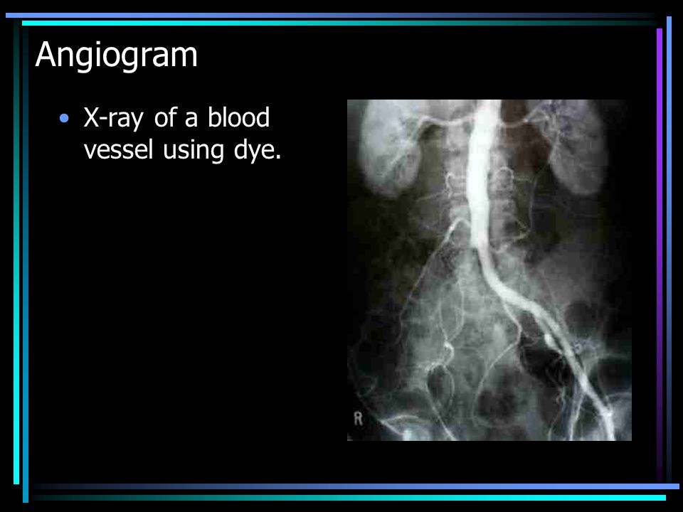 Angiogram X-ray of a blood vessel using dye.