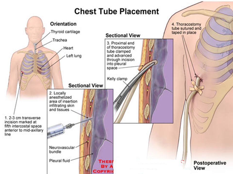 Mature tube needle