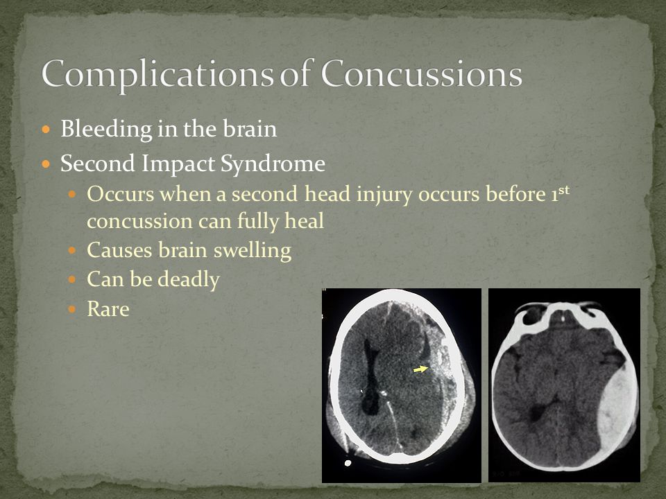 Bleeding in the brain Second Impact Syndrome Occurs when a second head injury occurs before 1 st concussion can fully heal Causes brain swelling Can be deadly Rare