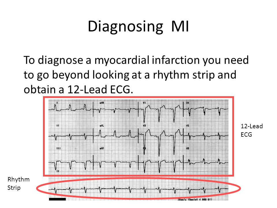 mi+ekg+strips mi+ekg+strips