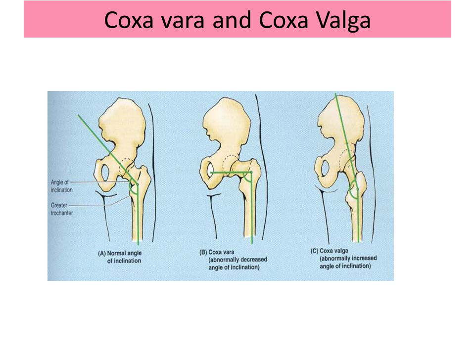coxa vara in adults aspiredeat tk coxa vara
