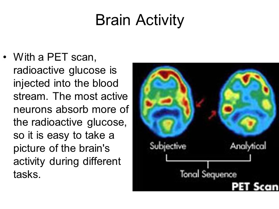 Brain Activity With a PET scan, radioactive glucose is injected into the blood stream.