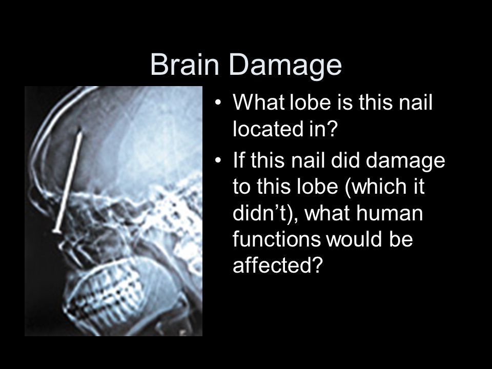 Brain Damage What lobe is this nail located in.