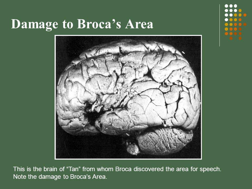 Damage to Broca’s Area This is the brain of Tan from whom Broca discovered the area for speech.